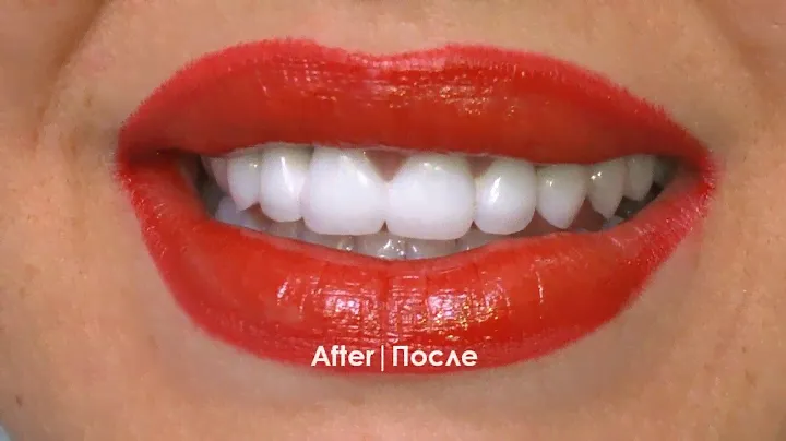 Dr  Azamat  Tekuyev   Smile Designer  stomatologiya  metal ceramic Crowns